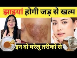 चेहरे की झाइयों को जड़ से ख़त्म करने के घरेलू उपाय | Home Remedy For Melasma |