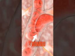 ¿Trombosis? 🩸 Por esto se genera…. #trombosis #causas #coagulation #embolo #drwilsondelgado