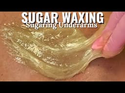 SUGARING UNDERARMS | SUGAR WAX #waxing #sugaring #hairremoval #sugarwax