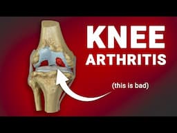 4 Easy Ways To Treat Knee Arthritis Without Drugs (ft. the Kineon Move+ Pro)