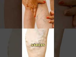 Por esto salen las varices #drwilsondelgado #tips #varices #causas #venas