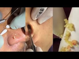 8 Minutes Of Top ASMR Pimple Popping Video