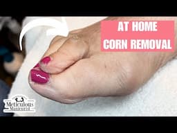 Corn Removal at Home on Toe