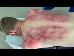 Holy Purple Bruising 😳 EXTREME REACTION TO GUA SHA - Sciatica & Joint Pain Need Help!