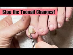 Fixing Toenails that Change Shape and Color