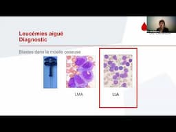 Comprendre la leucémie lymphoblastique aigue (LLA): La conférence sur la leucémie 2024