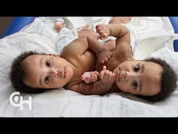 Separation of Conjoined Twins Amari and Javar