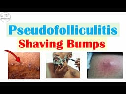 Pseudofolliculitis Barbae & Pubis (Shaving Bumps): Causes, Pathophysiology, Complications, Treatment