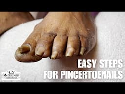 Fix your Ingrown Pincer Nails at Home