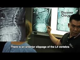 Spondylolisthesis in Walker GET HELPED from DC Sean Lee Gonstead Chiropractor 脊椎滑脱 坐骨神经痛 腰痛徒手治疗