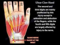 Ulnar Claw Hand Deformity: Diagnosis, Causes, and  Differential Diagnosis.