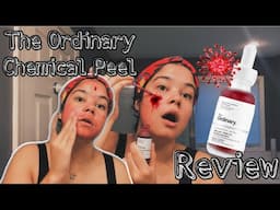 OMG! I TRIED THE ORDINARY PEELING SOLUTION...