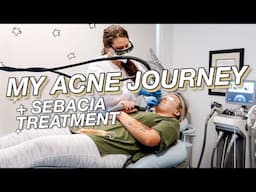 My Acne Journey + Sebacia Acne Treatment | Dealing With Adult Acne