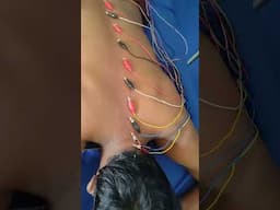 whole spine treatment #acupuncturetreatment  #chiropracticinandhrapradesh #mannuvaltheraphy