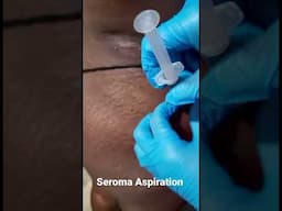 Seromas Aspiration || Seroma Drainage || Finer Beauty Spa || Geydi Guerrero