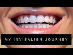 MY INVISALIGN JOURNEY! | Haleigh Markar