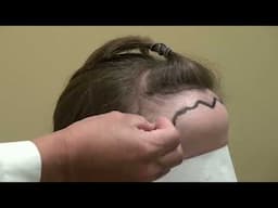 Restoring Feminine Hairlines: Techniques for High Hairline Correction in Women San Jose