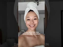 Getting my 2nd round of #rejuran  so here’s an skin update #skincare #koreanbeauty #skinbooster