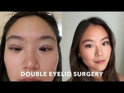 I GOT DOUBLE EYELID SURGERY IN KOREA | Experience, Recovery, Before + After