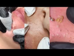 17 Minutes Of Top ASMR Pimple Popping Video